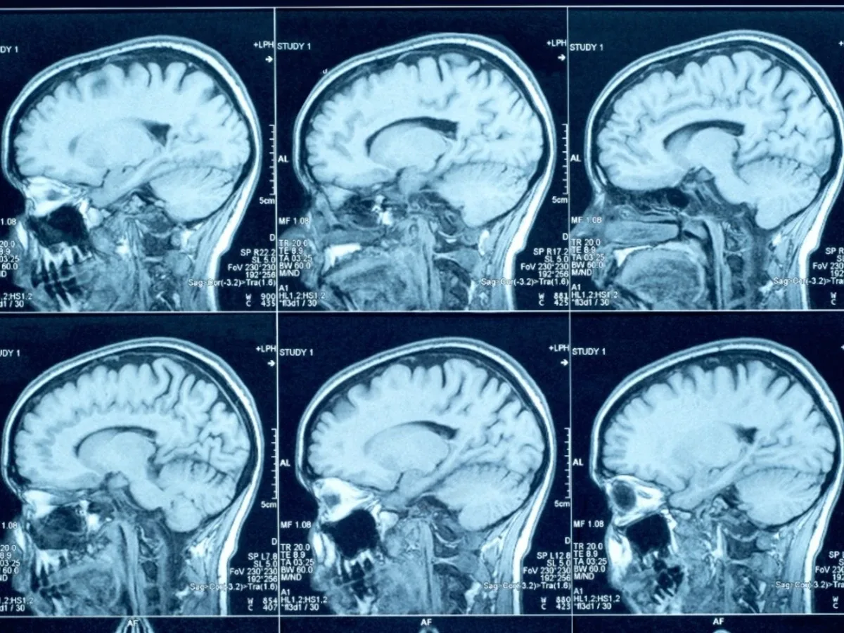 Sinais tardios após quedas podem indicar hematoma subdural crônico
