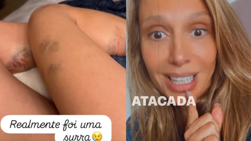 Luisa Mell relata ataque de dois cachorros e mostra hematomas nas pernas