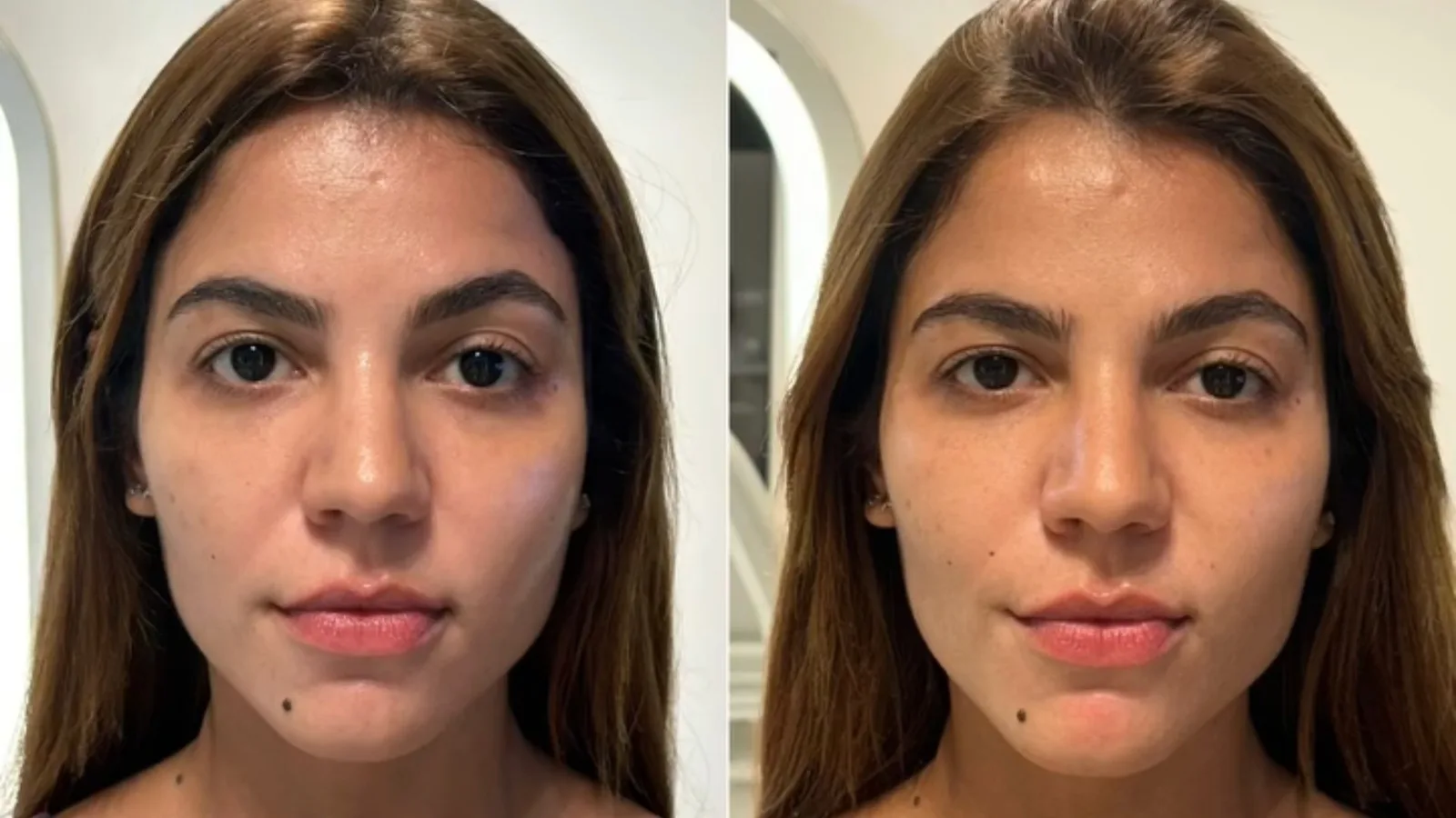 Hariany Almeida mostra mudança no rosto após botox e preenchimento
